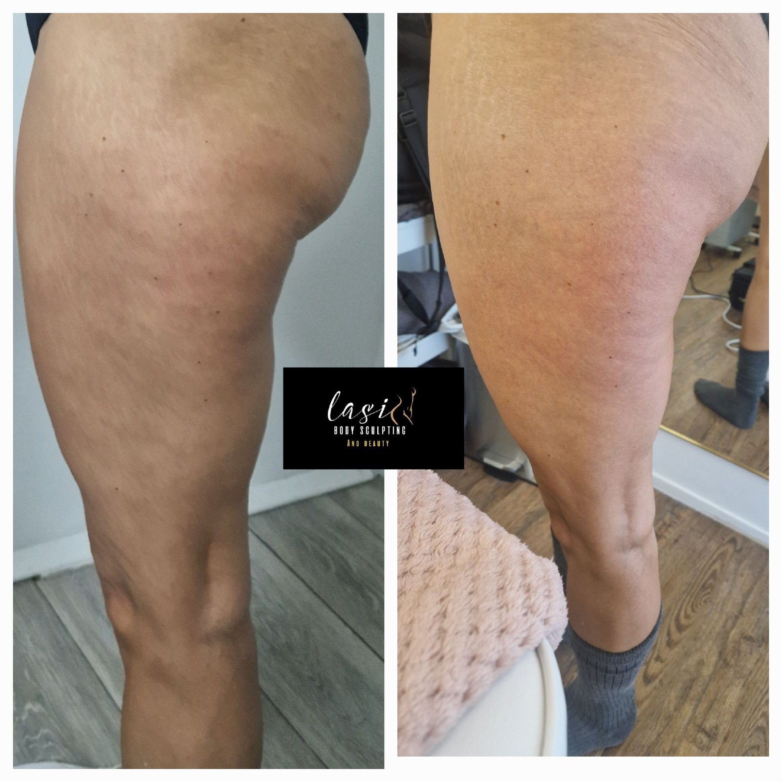 pre cellulite reduction treatment and post cellulite reduction treatment image